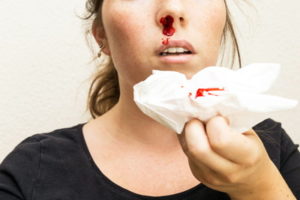 woman with a broken and bloody nose